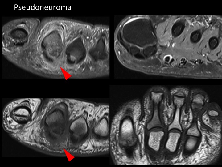Figure 4 for case plantar plate of metatarsophalangeal joint ( RID3134 )